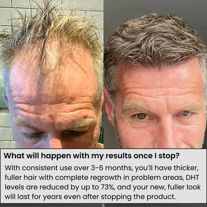 Alphainfuse™ Hair Regrowth System