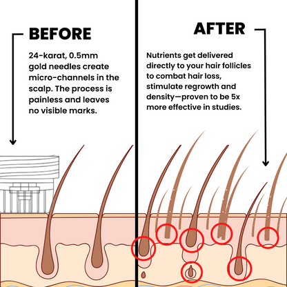 Alphainfuse™ Hair Regrowth System