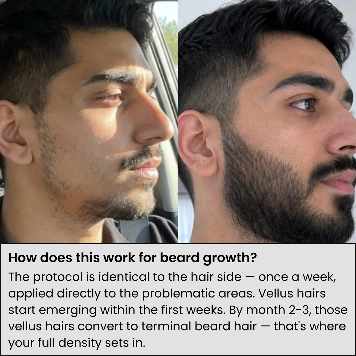 Alphainfuse™ Hair Growth System