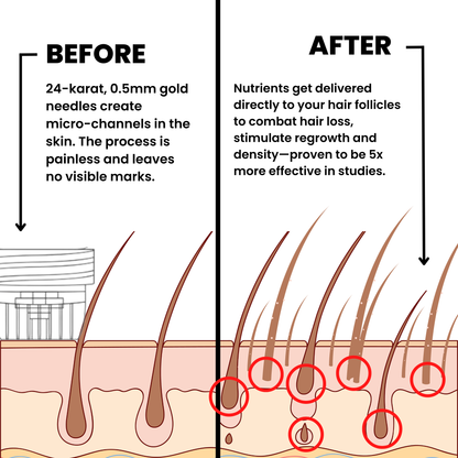 Alphainfuse™ Hair Growth System
