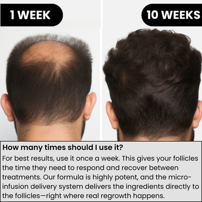 Alphainfuse™ Hair Growth System