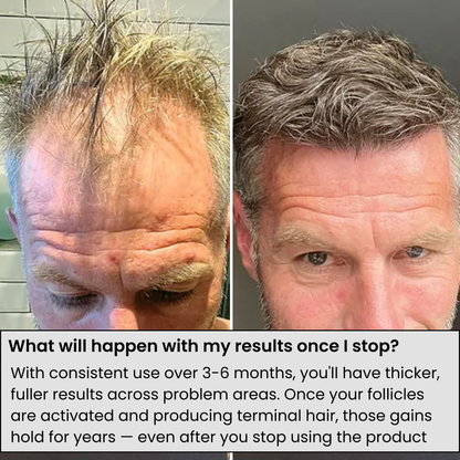 Alphainfuse™ Hair Growth System